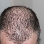 Wenn Sie an Haarausfall leiden, können verschiedene Maßnahmen ergriffen werden, um das Problem zu bekämpfen.